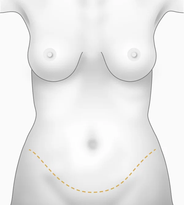 Illustration abdominoplastie, cicatrices