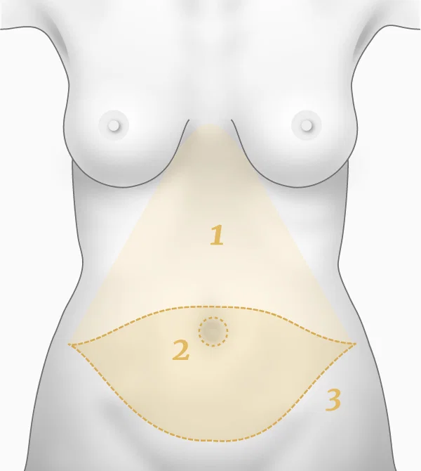 Illustration principe de l'abdominoplastie