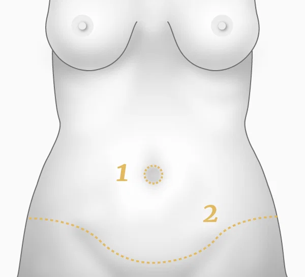 Illustration bodylift face - cicatrices