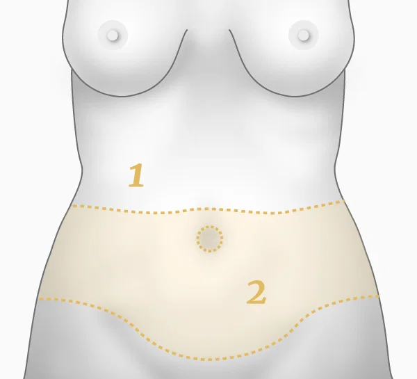 Illustration bodylift face - principe