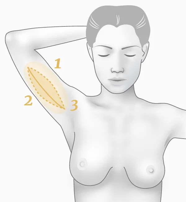 Illustration brachioplastie, technique à cicatrice verticale - principe