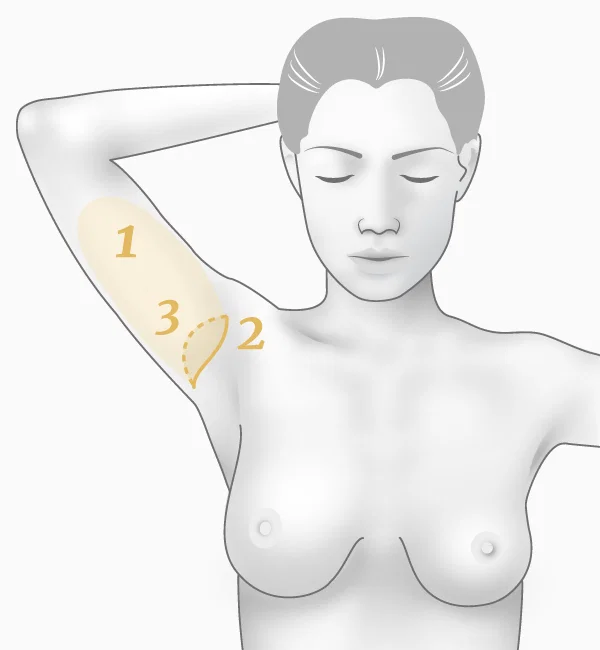 Illustration brachioplastie, technique à cicatrice horizontale - principe