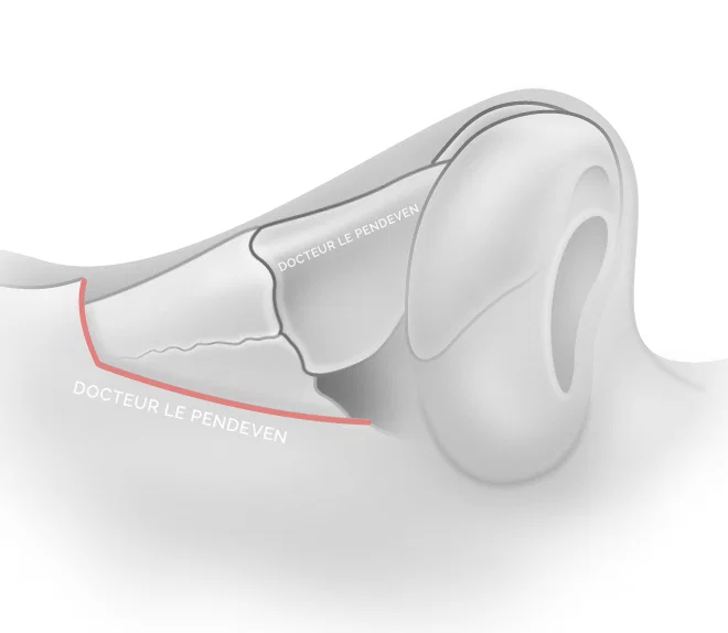 illustration 'Impaction de la bosse'