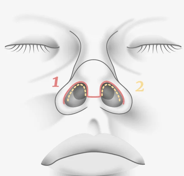 Illustration rhinoplastie, cicatrices