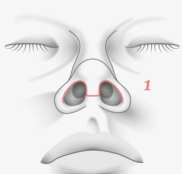 Illustration rhinoplastie Ultrasonique, cicatrices