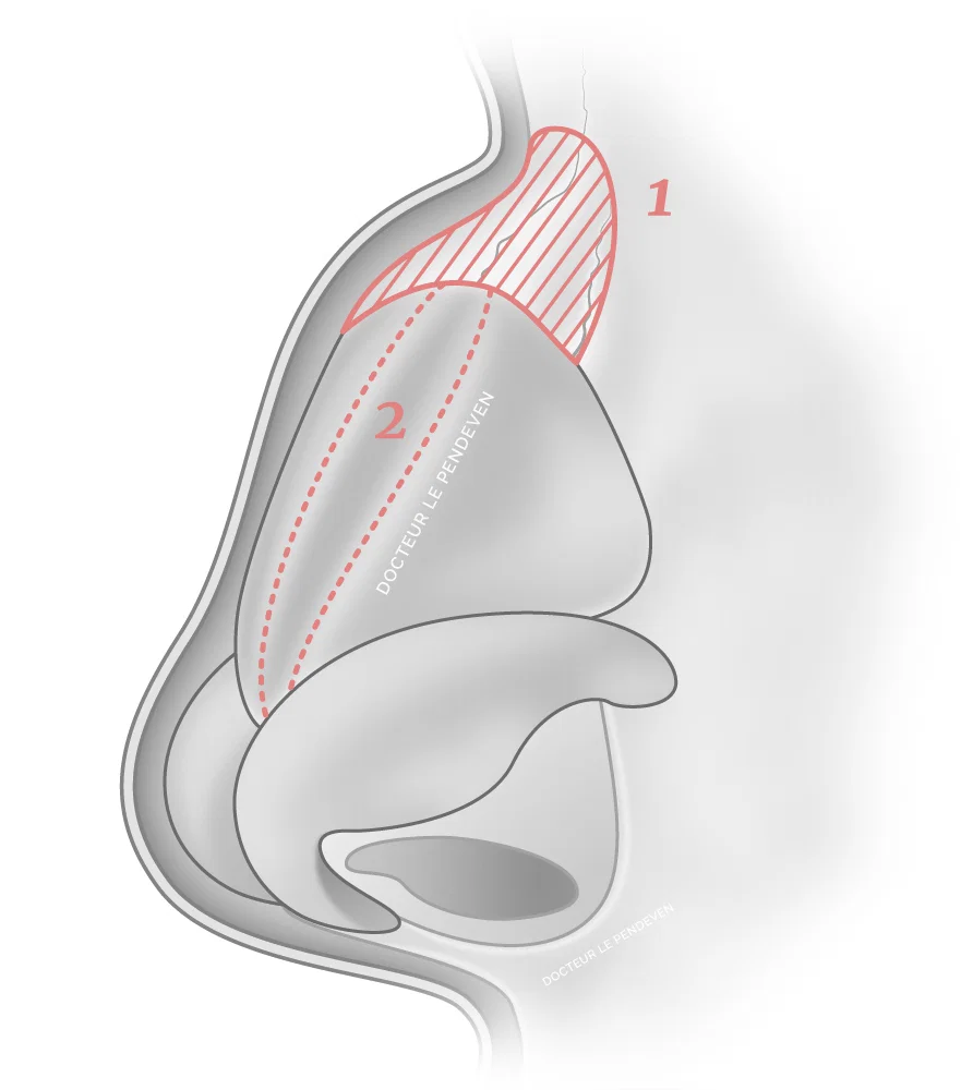 illustration 'Traitement d'une bosse en Spreader Flap'