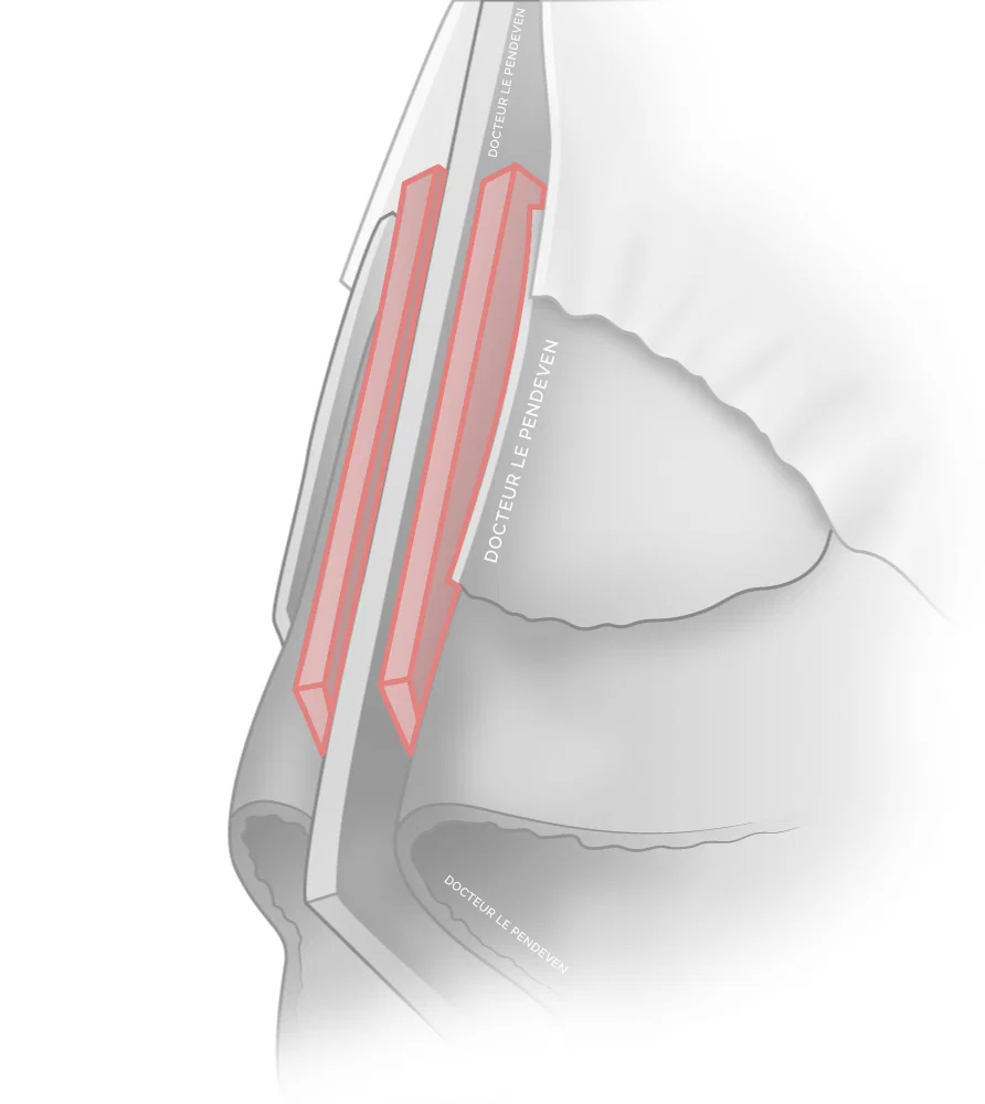 illustration 'Traitement d'une bosse en Spreader Flap'