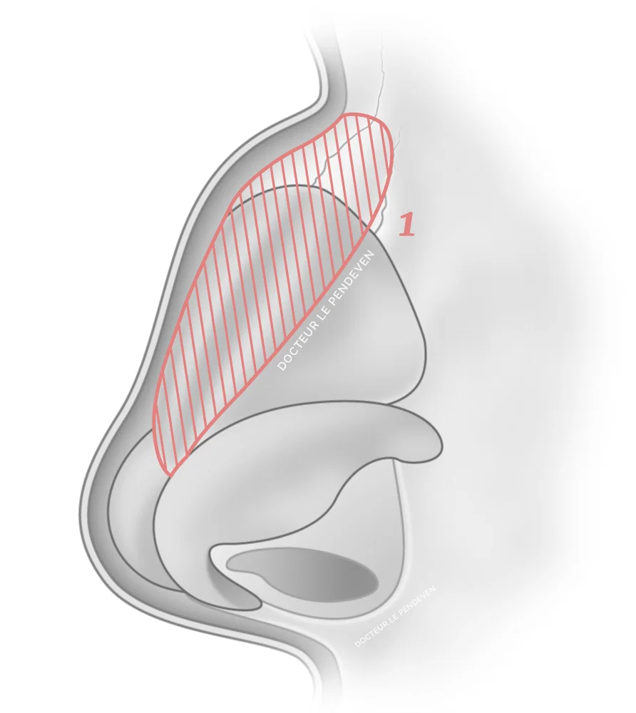 illustration 'Traitement d'une bosse en Spreader Graft'