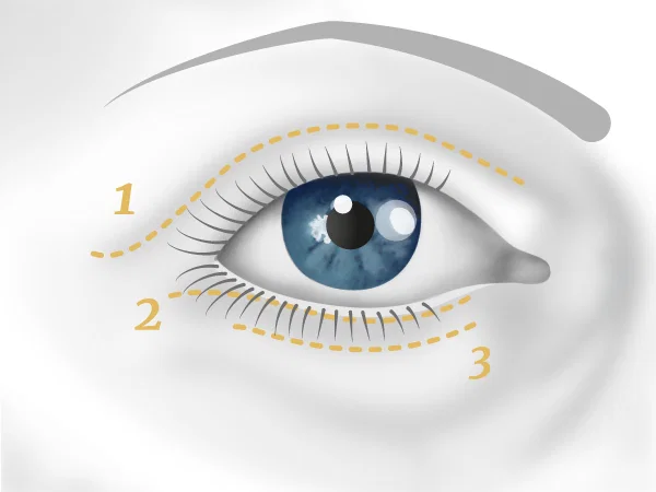 Illustration blépharoplastie, cicatrices