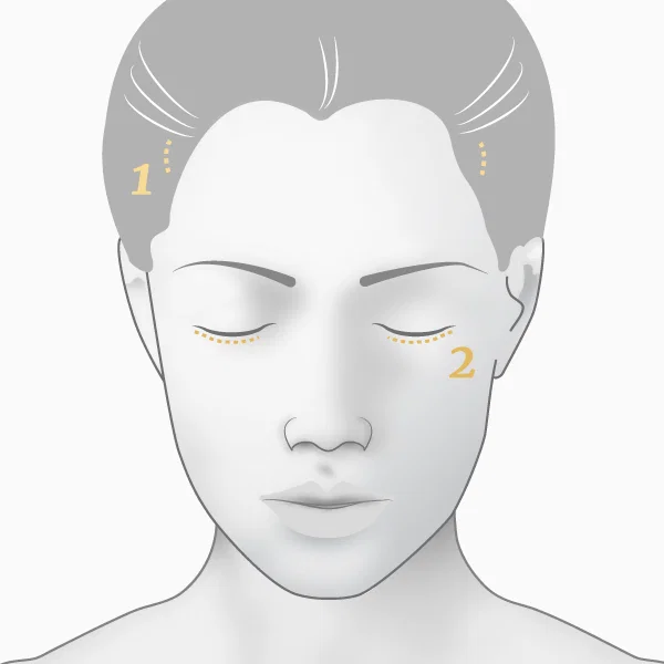 Illustration lifting-vertical cicatrices