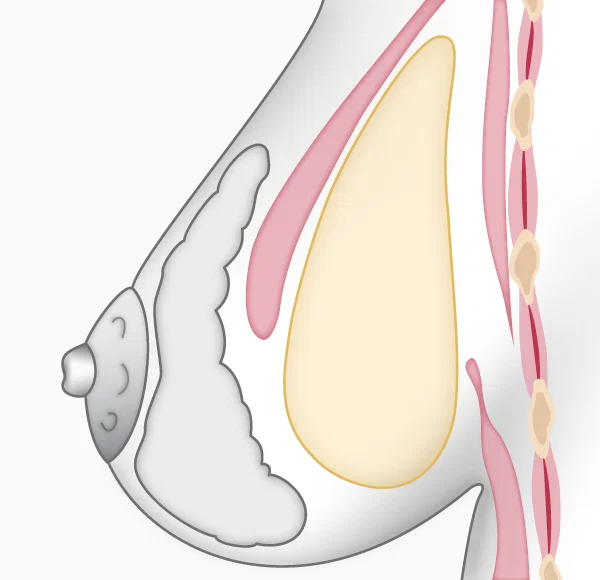 Illustration augmentation mammaire, prothèse en arrière du muscle