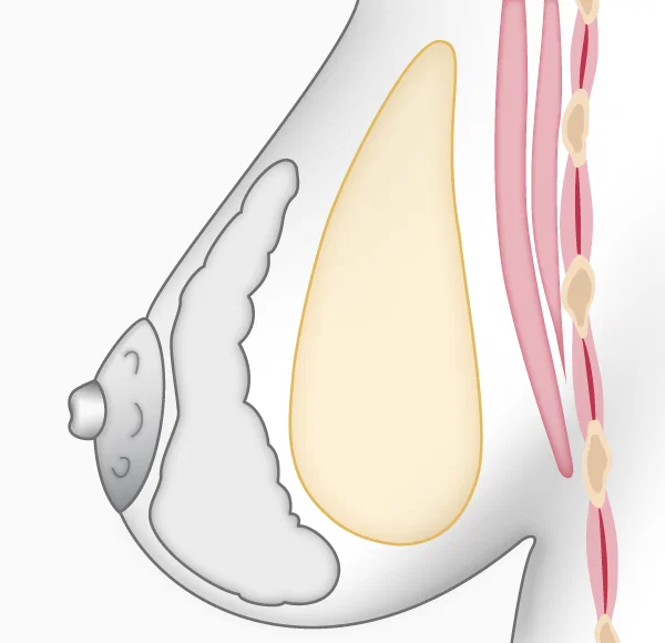 Illustration augmentation mammaire, prothèse en avant du muscle