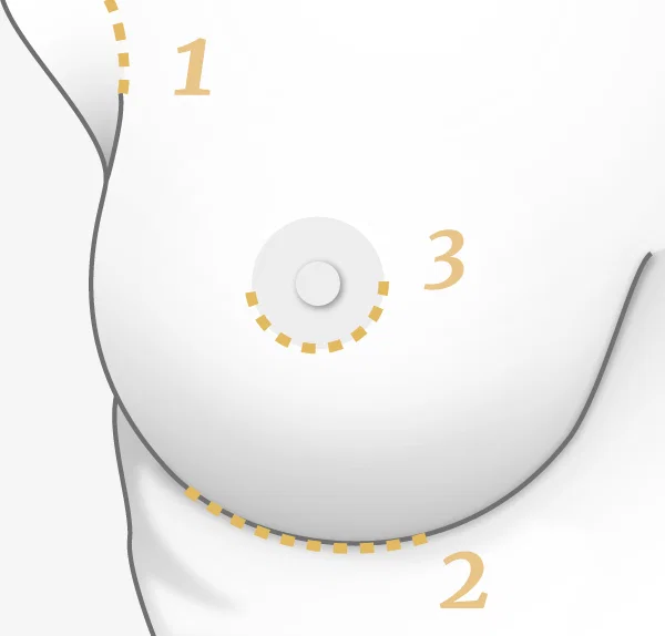 Illustration augmentation mammaire, cicatrices