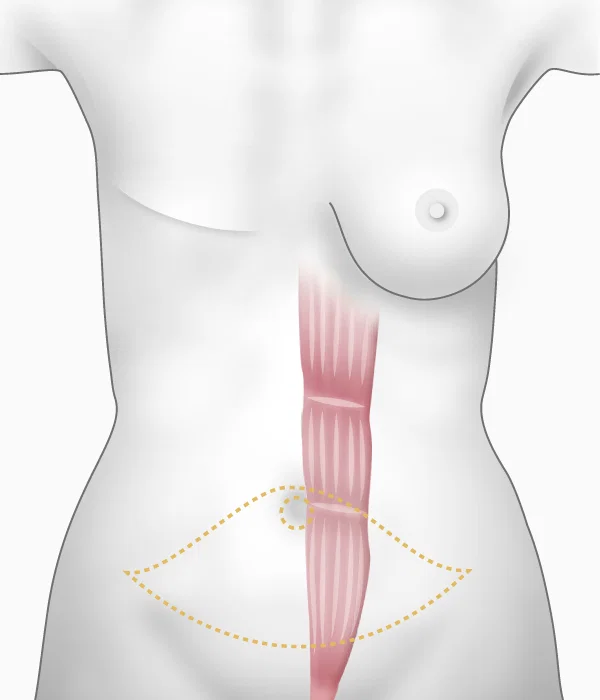 Illustration du prélèvement du muscle 'grand droit' de l'abdomen