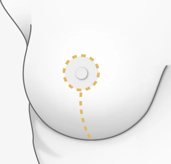 Illustration chirurgie mammaire, technique à deux cicatrices