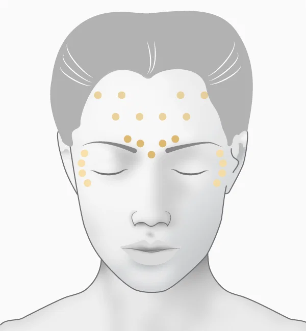Illustration toxine botulique, zones d'injection